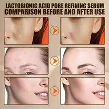 Pore Shrink Face Serum - Acne Control & Blackhead Remover